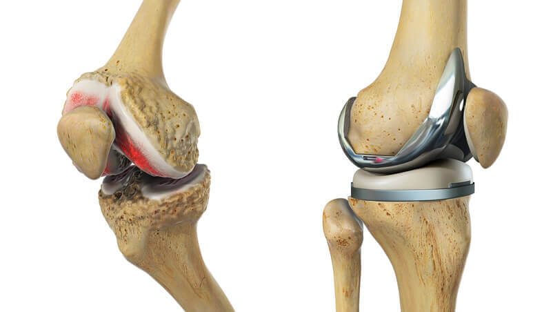 Knee Surgery Illustration